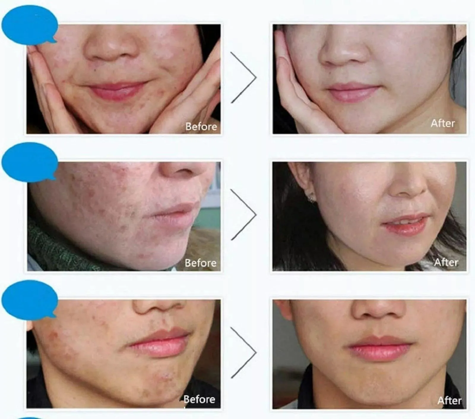 BIOAQUA Skin Care Acne Face Removal Cleanser Cream Spots Scar Blemish Mark 100g
